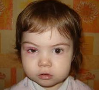 Симптомы ячменя на глазу у ребенка
