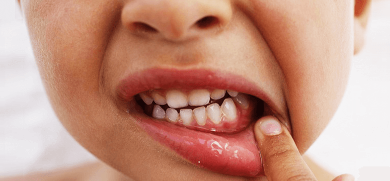 Могут ли выпасть зубы, если запустить болезнь?